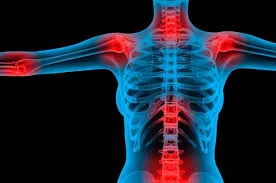 Entre as doenças crônicas está a fibromialgia, que causa dores nas costas e nas articulações Fonte: Agência Câmara de Notícias